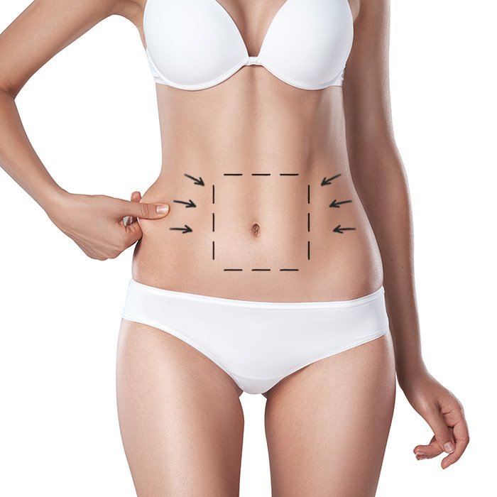 Equipo médico realizando procedimiento de cirugía plástica de abdominoplastia
